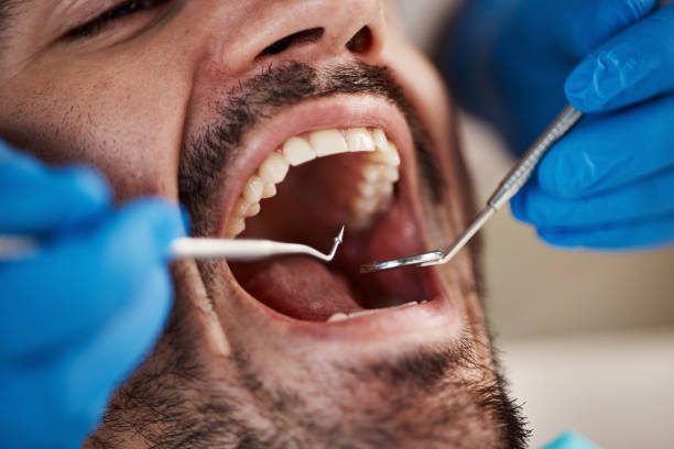 Best Knocked-Out Tooth (Avulsed Tooth) Treatment in Jackson, TN