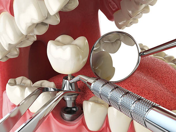 Best Lost Filling or Crown Replacement in Jackson, TN